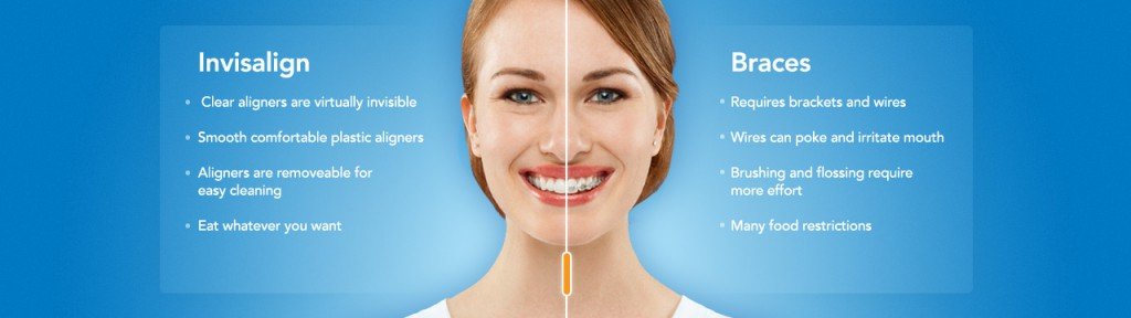 invialign-vs-braces
