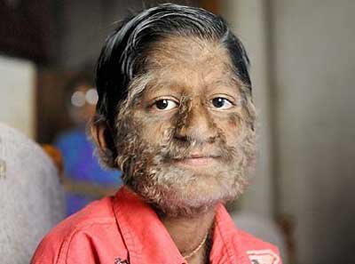 hypertrichosis-jpg